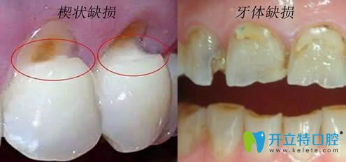 牙体缺损和楔状缺损是一样的吗