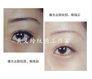 上海洗眉-激光洗眉多少钱黄义玲顶级纹绣专业洗眉纹眉