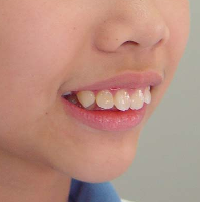 牙齿不齐对孩子有哪些影响