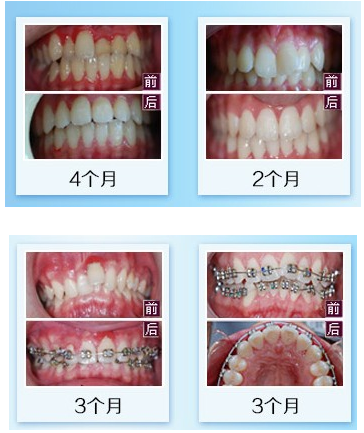 郑州牙科医院整牙齿要多少钱