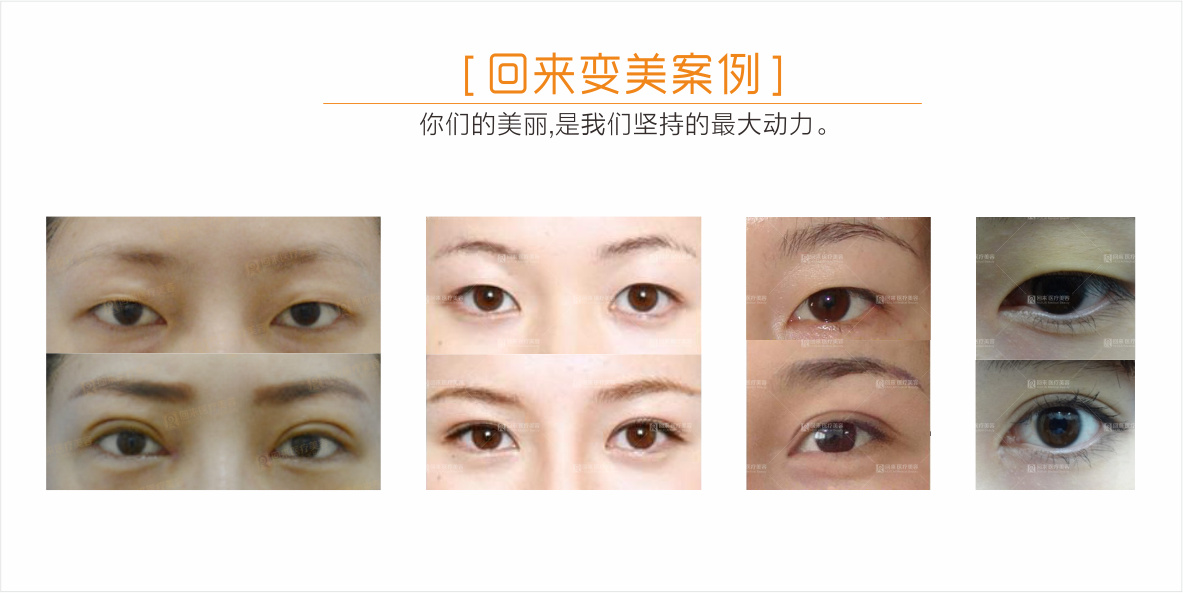 如何变成双眼皮回来医疗美容双眼皮手术就能帮到你
