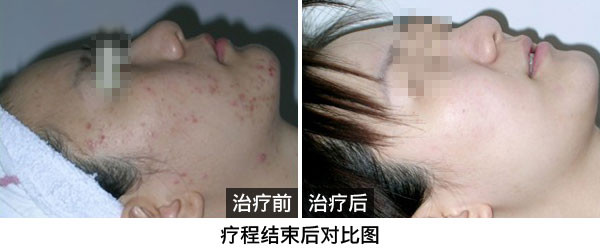 青春期长出来的青春痘痘痘在天津哪里可以快点祛除