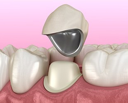 香港全口义齿 局部可摘义齿 3D 打印/设计 假牙义